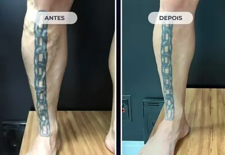 Perna após o tratamento com a Técnica ATTA